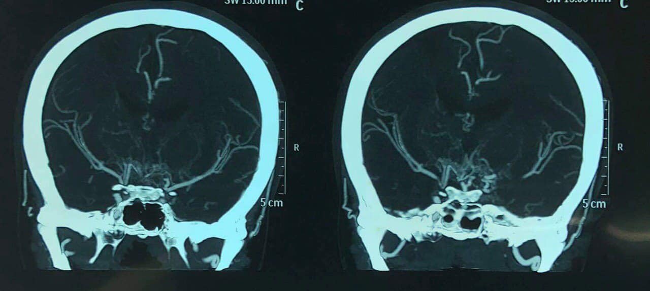 Iraqi physicians perform the first operation of its kind in Iraq for a Moyamoya patient