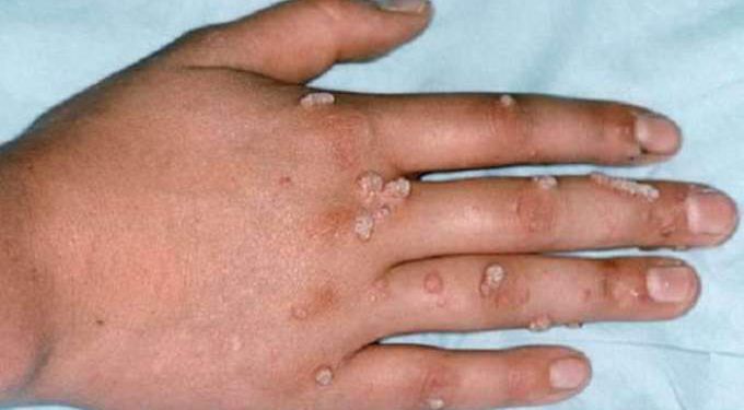 Monkeypox More than  contacts tracked in US for rare disease