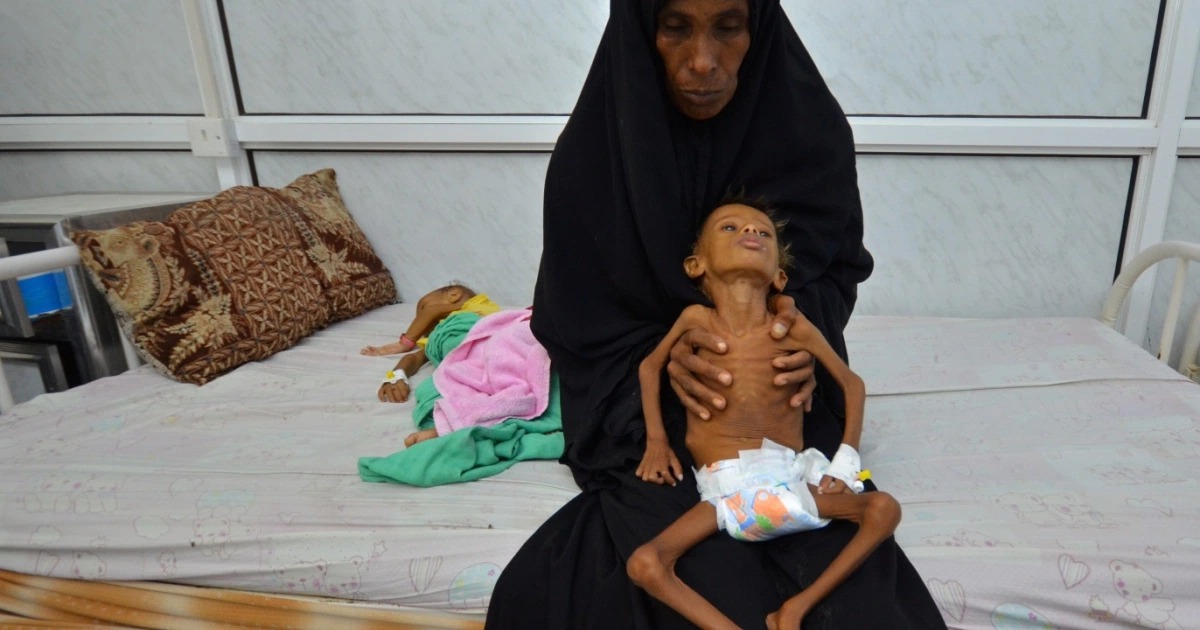 في اليمن.. طفل يموت كل 10 دقائق و15 مليون إنسان على حافة المجاعة