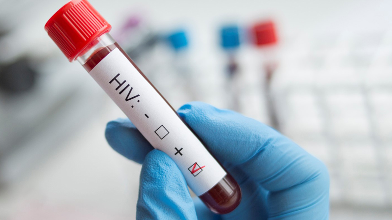 New highly virulent HIV variant detected in the Netherlands 