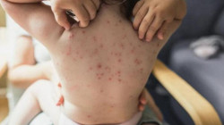 WHO: Monkeypox presents a moderate risk to public health