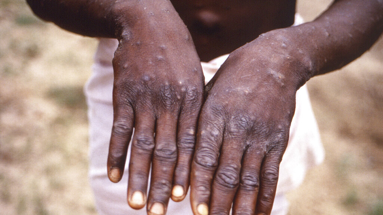 Monkeypox case count rises to more than 3,200 globally – WHO
