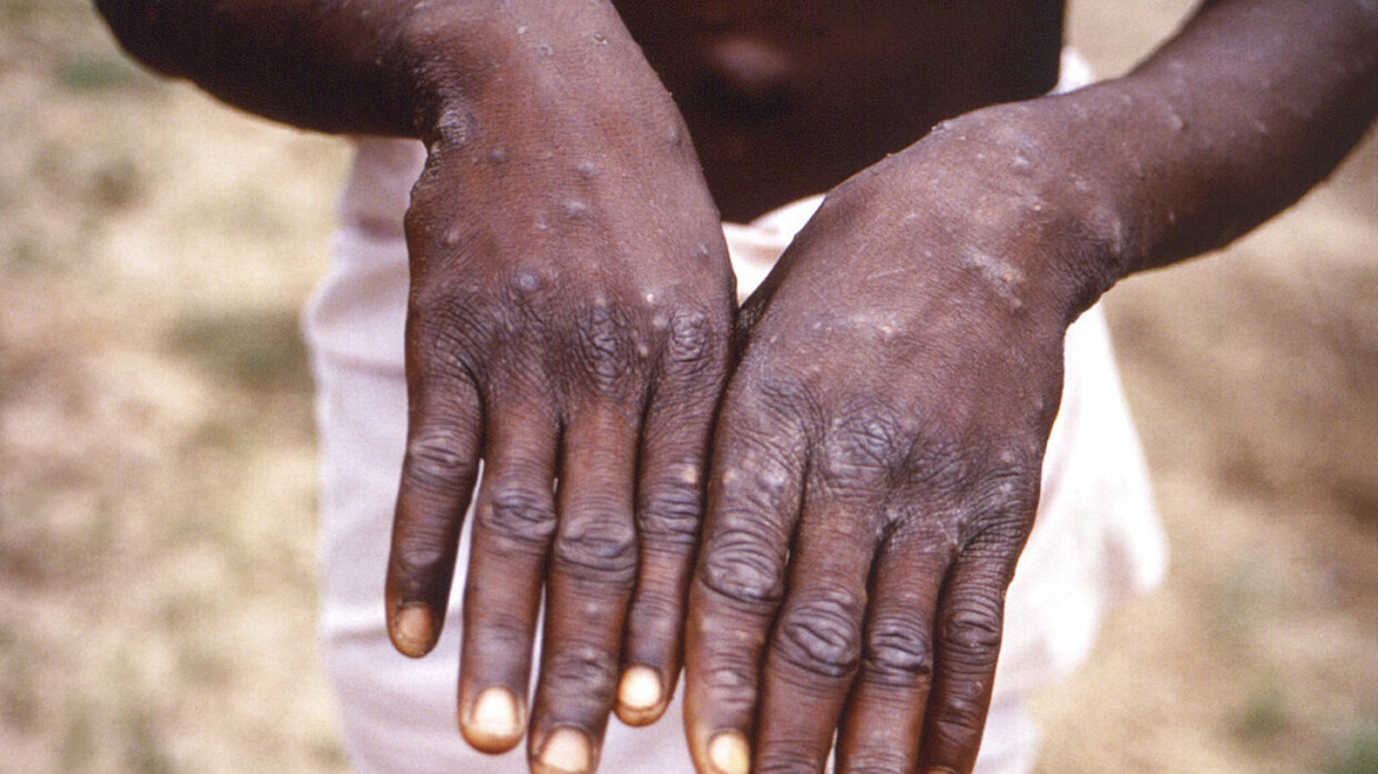 Monkeypox case count rises to more than  globally  WHO