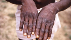 Monkeypox symptoms differ from previous outbreaks - UK study