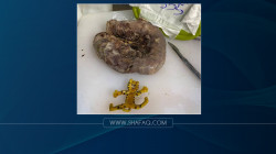 العثور على لعبةٍ مطاطيةٍ داخل أمعاء شاب عراقي