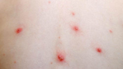 وثيقة .. تسجيل إصابات مؤكدة بمرض "جدري الماء" في مدارس محافظة عراقية