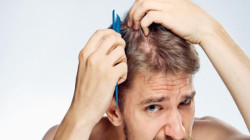 دراسة تحذر من مشروبات تؤدي إلى تساقط الشعر عند الرجال