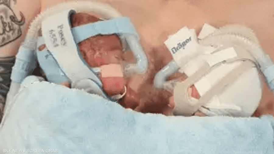 معجزة حقيقية.. ولادة توأمين في الشهر السادس وبقائهما على قيد الحياة