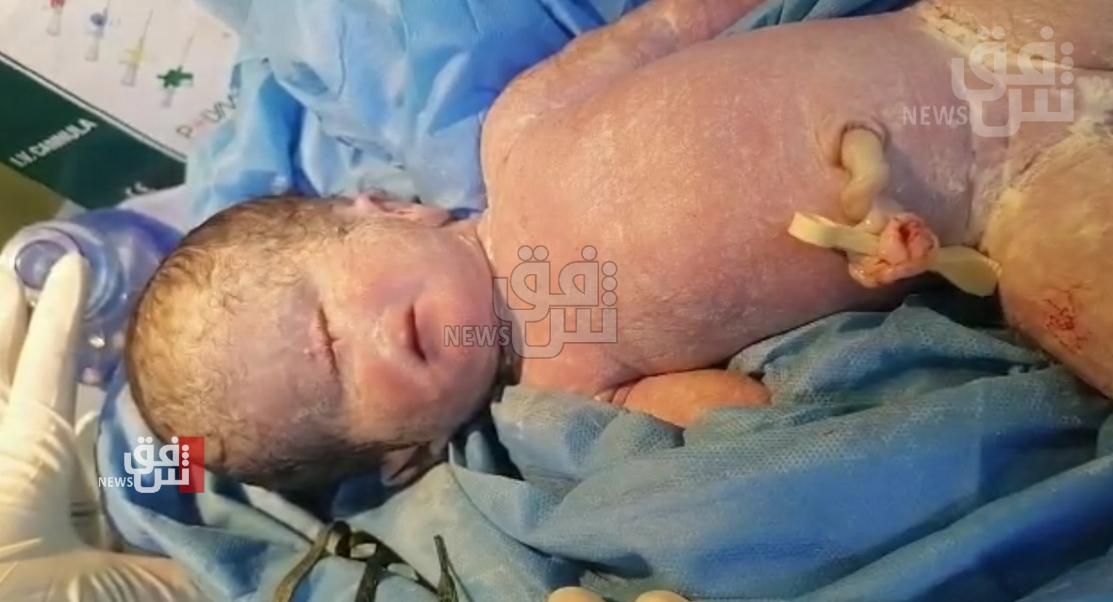 حالة غريبة في العراق.. ولادة طفلة بعين واحدة  (فيديو)