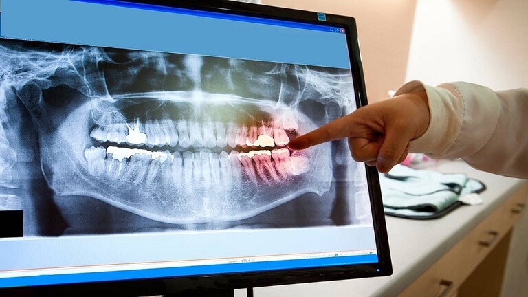 علماء أمريكيون يستخدمون الذكاء الاصطناعي لاكتشاف تسوس الأسنان