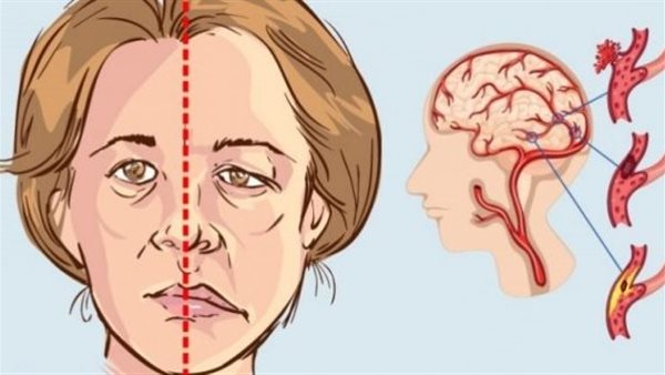 ما هي أعراض السكتة الدماغية لدى النساء؟