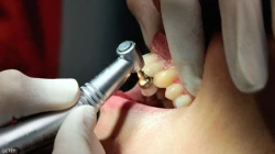 امرأة تقاضي طبيب أسنان أجرى لها 32 عملية في زيارة واحدة