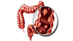 "فيتامين D والمكسرات" يقللان من خطر الاصابة بسرطان القولون