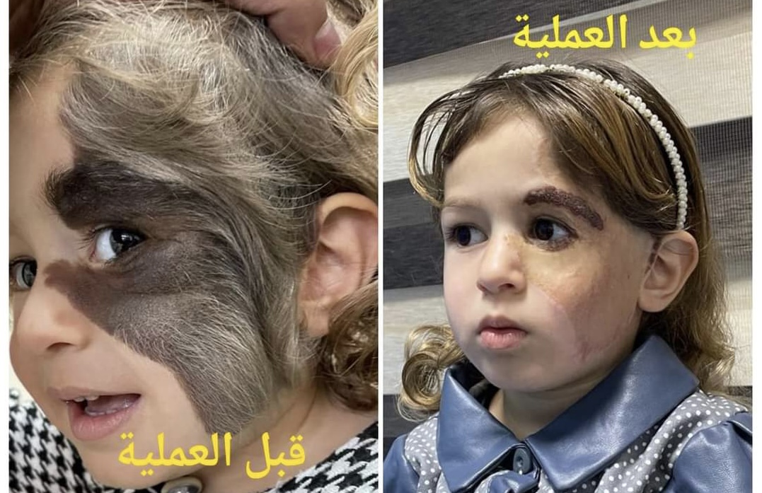 فريق طبي عراقي ينجح بترميم وجه طفلة بعمر 3 سنوات