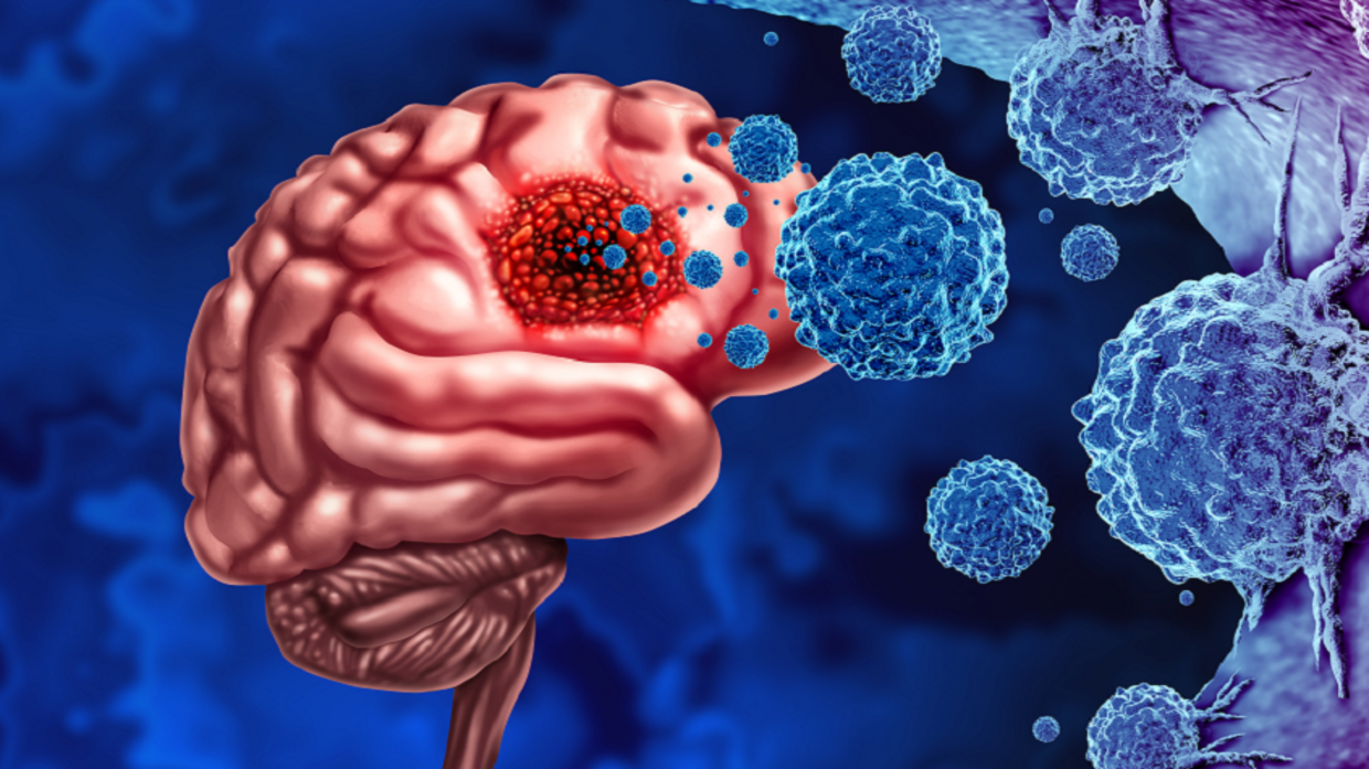 علماء يكتشفون "علاجاً محتملاً" لسرطان الدماغ