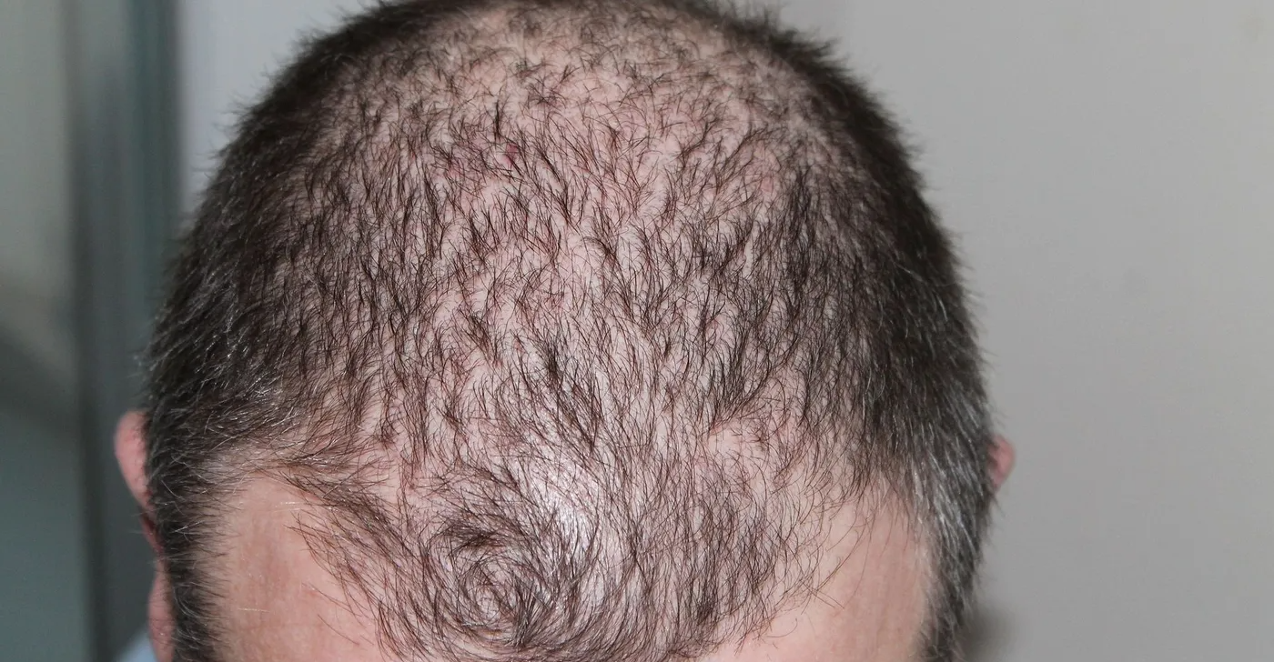 تحذير طبي.. الصيام المتقطع يهدد شعرك ويزيد من خطر الصلع