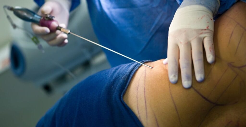 کارەسات.. نەشتەرگەری لاوردن چەوری کۆتایی وە ژیان داڵگ دوو مناڵ تیارێد لە سلێمانی