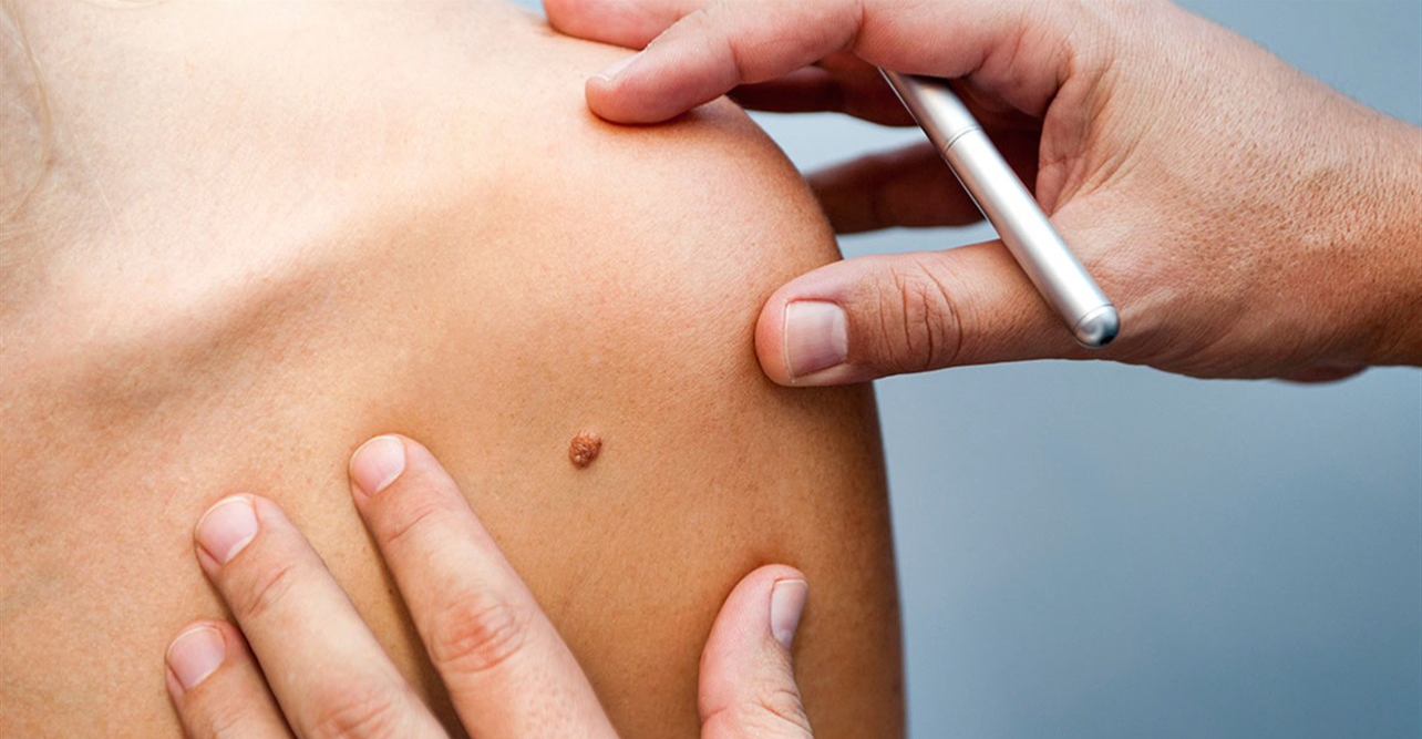 ماهي علامات تشخيص "الشامة السرطانية"؟