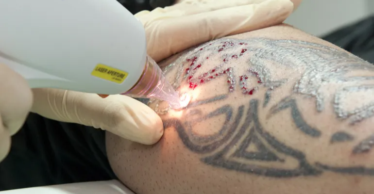 دراسة تربط "الوشم" بخطر سرطان الجلد