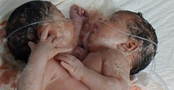 تیمیگ پزیشکی عراقی توەنێد نەشتەرگەری زایین دەگمەنیگ ئەرا لفانگ وەیەکەولکیاییگ ئەنجام بەێد