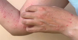 Iraq’s al-Anbar: Chickenpox outbreak among students “Not Alarming”