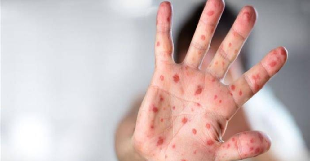 "الحصبة" تجتاح الولايات المتحدة والإصابات تقترب من الـ900 حالة