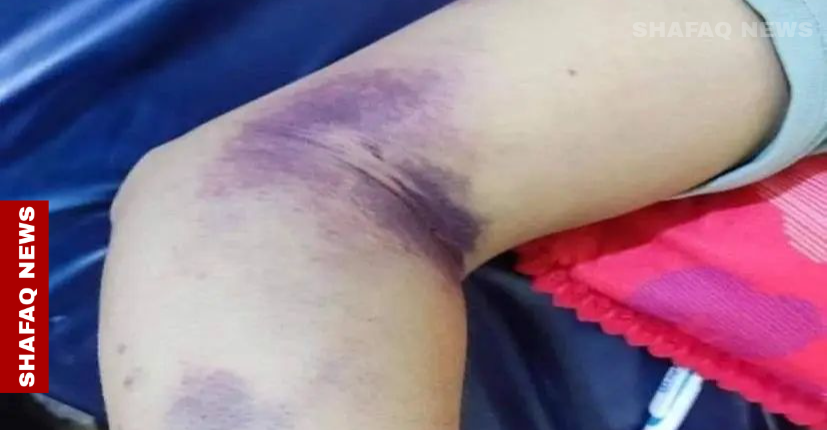 تسجيل 7 إصابات بالحُمى النزفية في البصرة بينها حالة وفاة
