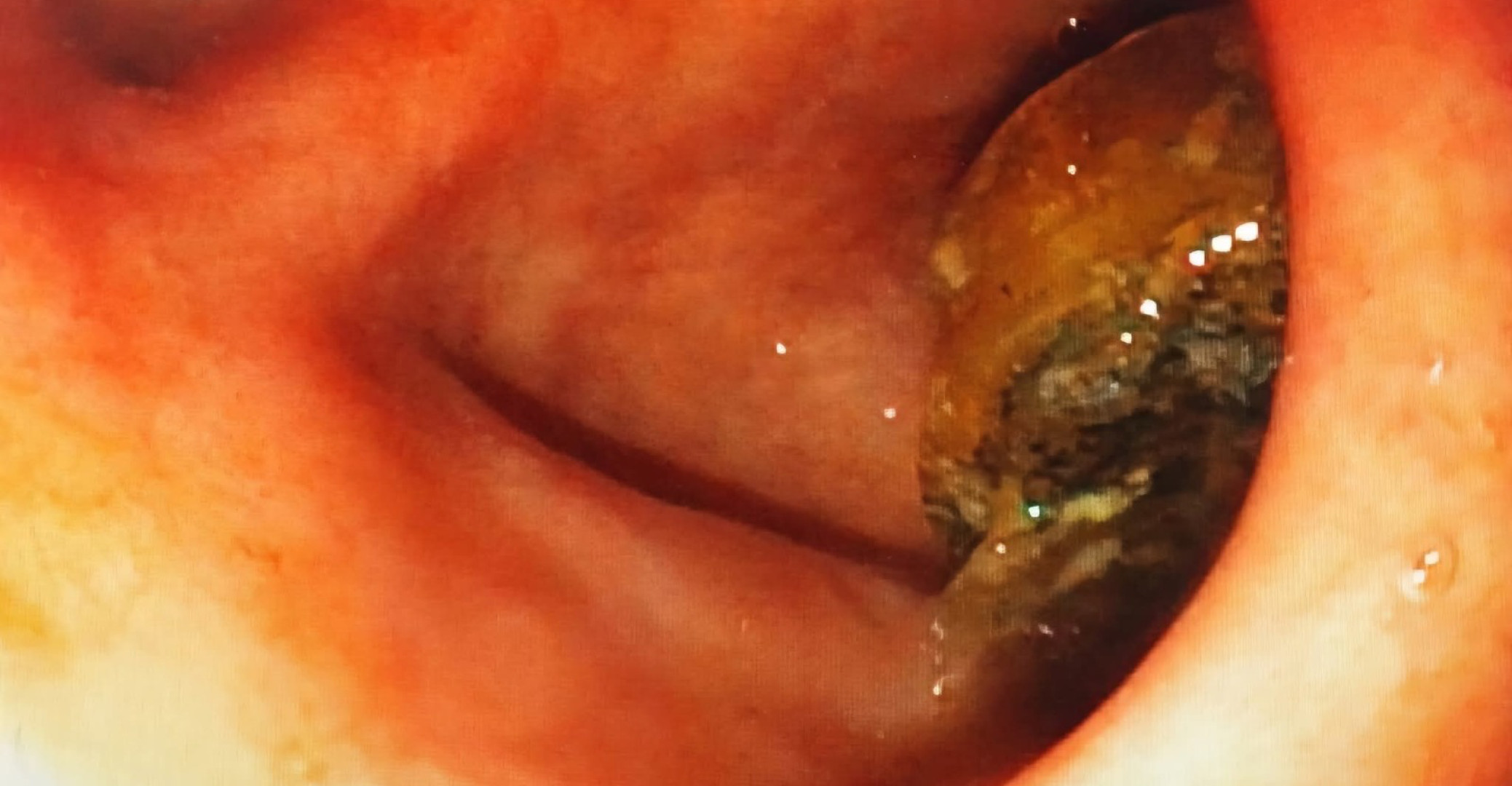 استخراج جسم غريب من معدة امرأة تسعينية (صور)