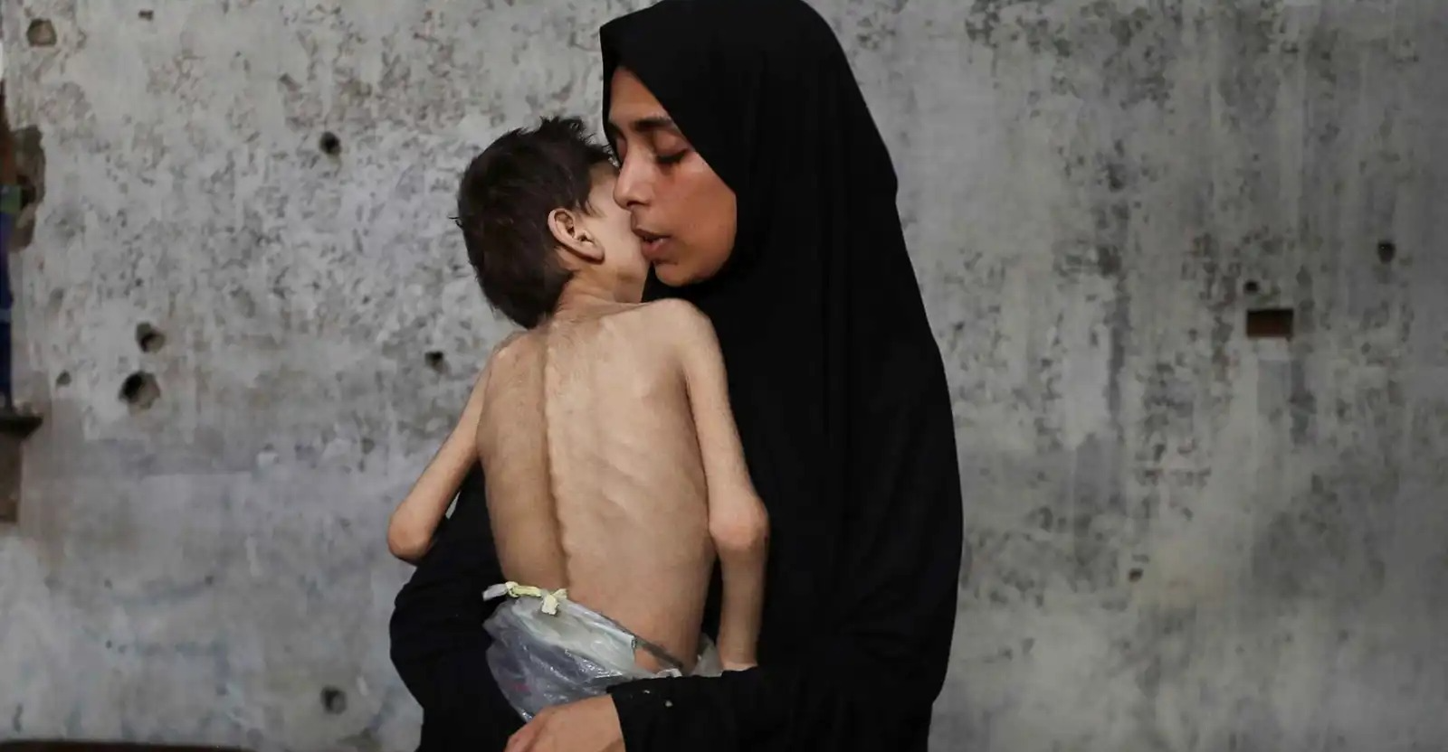 صحة غزة: 159 وفاة بينهم 90 طفلاً بسبب المجاعة وسوء التغذية