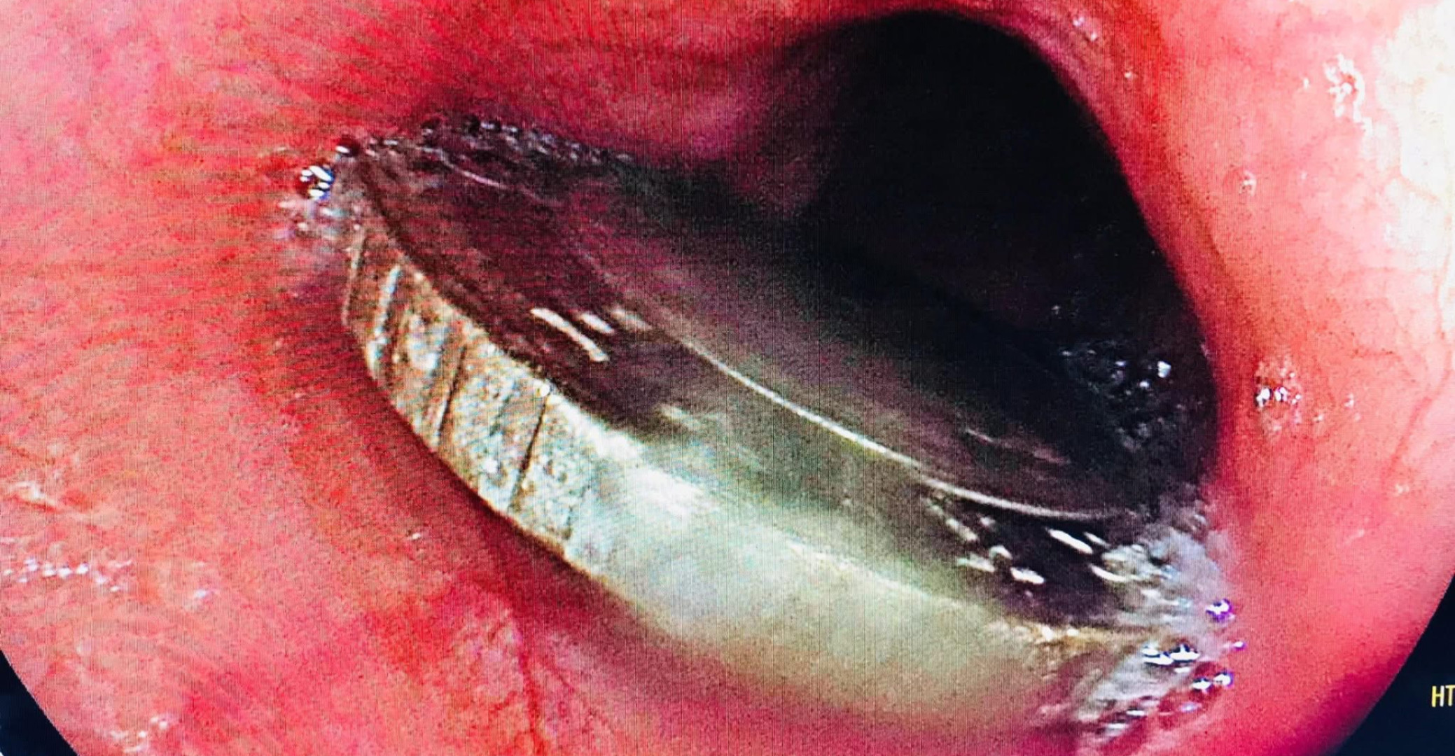 النجف.. إنقاذ طفلة ابتلعت عملة معدنية (صور)