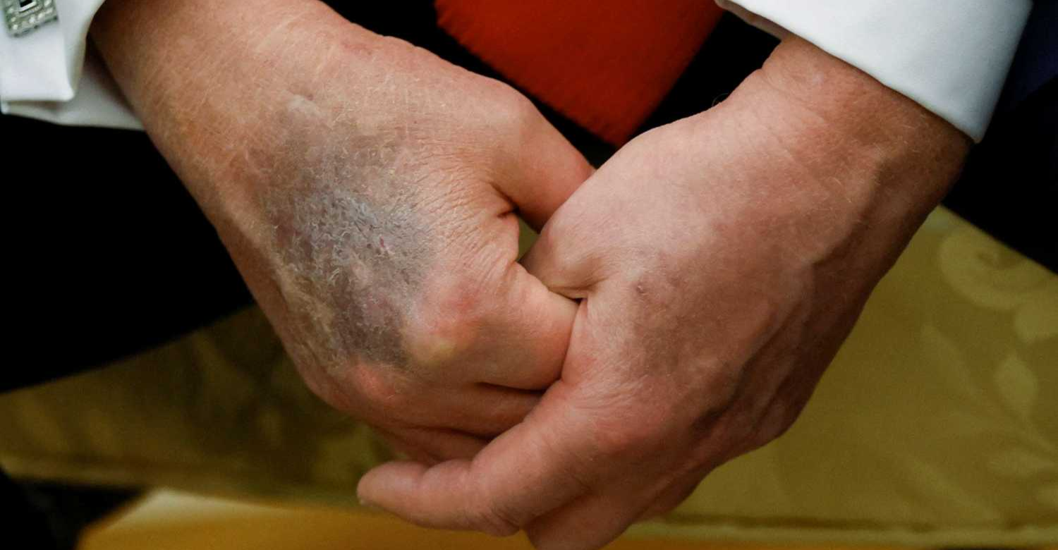 لەکەی کەویگ لەبان دەس ترەمپ پرسیار لەبان تەندروسیی دروس کەێد