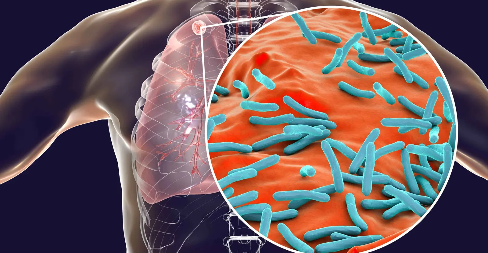 قتلت 10 ملايين.. كشف البكتيريا المسؤولة عن أول وباء في التاريخ