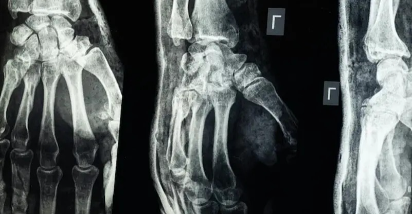 ابتكار طبي جديد يعالج الكسور خلال 3 دقائق