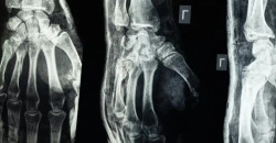 ابتكار طبي جديد يعالج الكسور خلال 3 دقائق