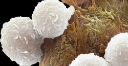 دراسة عالمية تتوقع قفزة في إصابات السرطان بحلول 2050