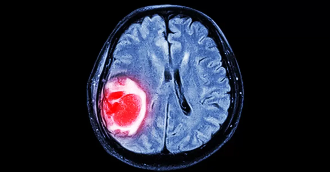 دراسة جديدة: القلق والدوخة يفاقمان الأورام الدماغية