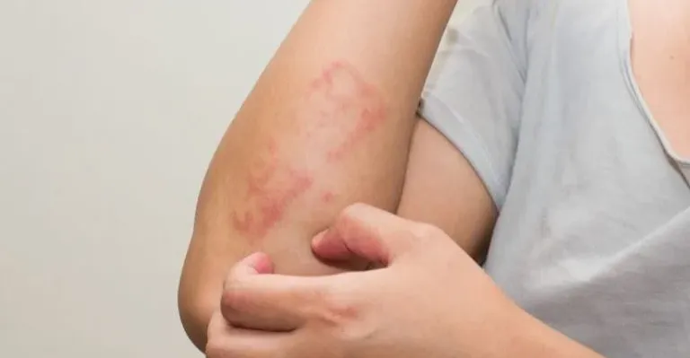 الجلد يعكس ما في الدماغ.. دراسة حديثة تربط الطفح الجلدي بالاكتئاب