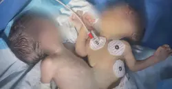 نجاح أول عملية لفصل توأم سيامي في كركوك