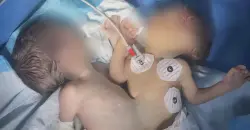 First conjoined twin separation performed in Iraq’s Kirkuk