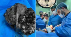 20 cm chest tumor removed in five-hour operation in Kirkuk