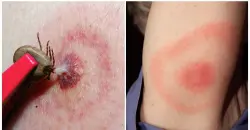 بعد عقود من التكتم.. تحقيق رسمي يكشف غموض انتشار مرض لايم في أميركا