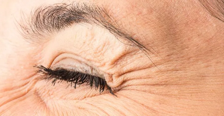 تجاعيد "أقدام الغراب" قد تنذر بخطر الخرف والزهايمر