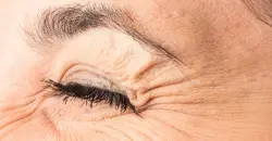 تجاعيد "أقدام الغراب" قد تنذر بخطر الخرف والزهايمر