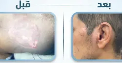 Iraqi surgeons reattach amputated ear in Dhi Qar