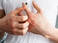 ئەگزیمای زمسانی و چەن رییگ ئەرا چارەسەری
