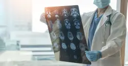 التجارب الذهانية العابرة في سن العشرين قد تؤثر على نضج الدماغ