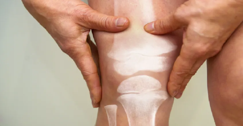 إنذار مبكر: هشاشة العظام تهدد نصف نساء الأرض