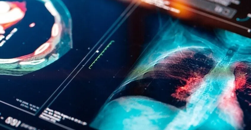 اختبار بسيط بالأظافر قد يكشف سرطان الرئة مبكراً