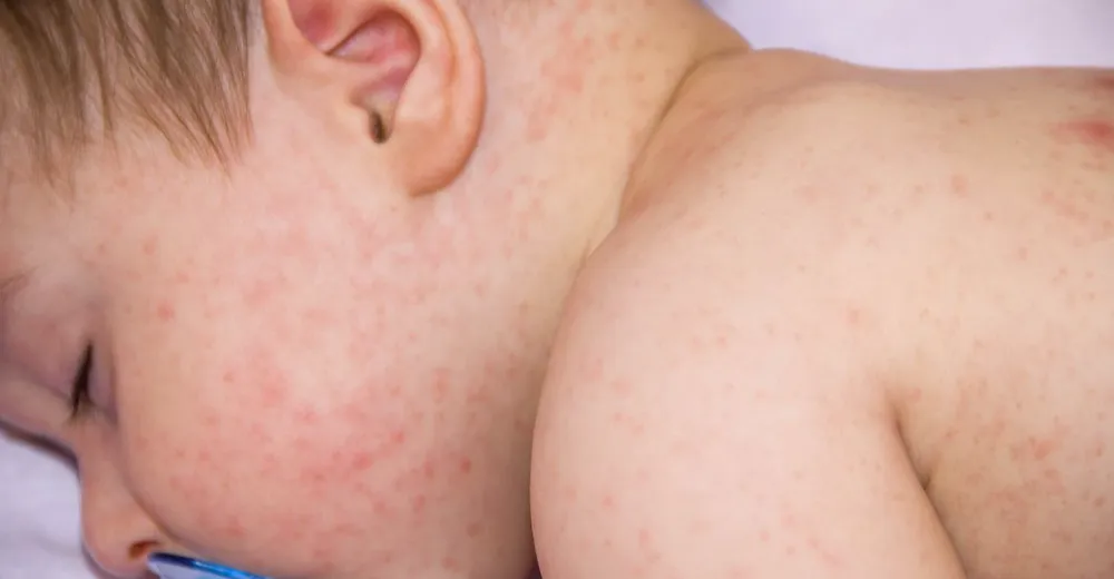 أسباب غير متوقعة لحساسية الطعام عند الأطفال