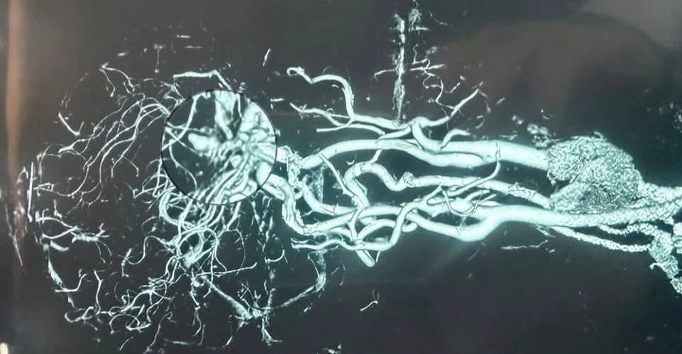 عملية مجهرية نادرة في كركوك تنقذ مريضاً من نزف دماغي خطير